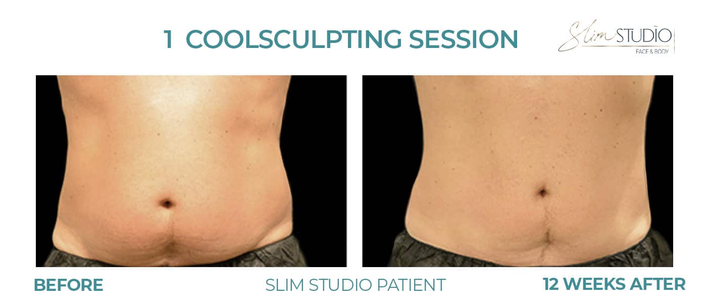 Before and After Image: CoolSculpting – Abs - front