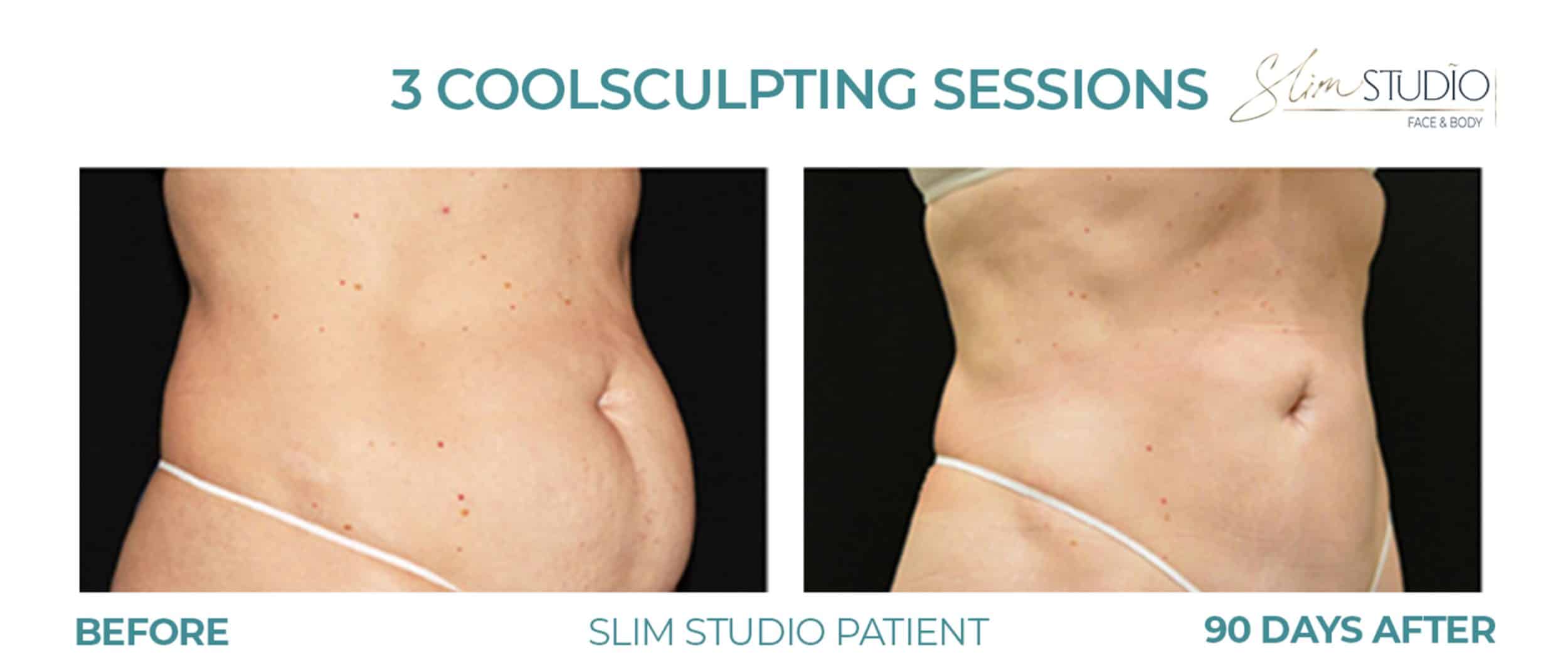 Before and After Image: CoolSculpting – Abs - right-front-oblique