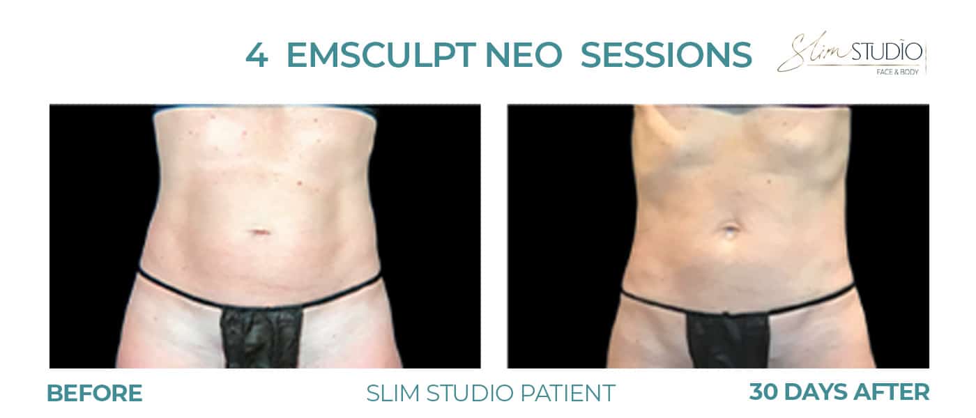 Before and After Image: EMSculpt NEO – Abs - front