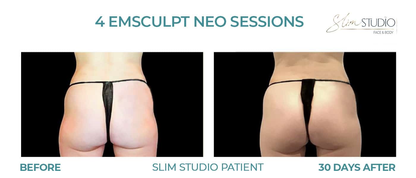 Before and After Image: EMSculpt NEO – Glutes - back