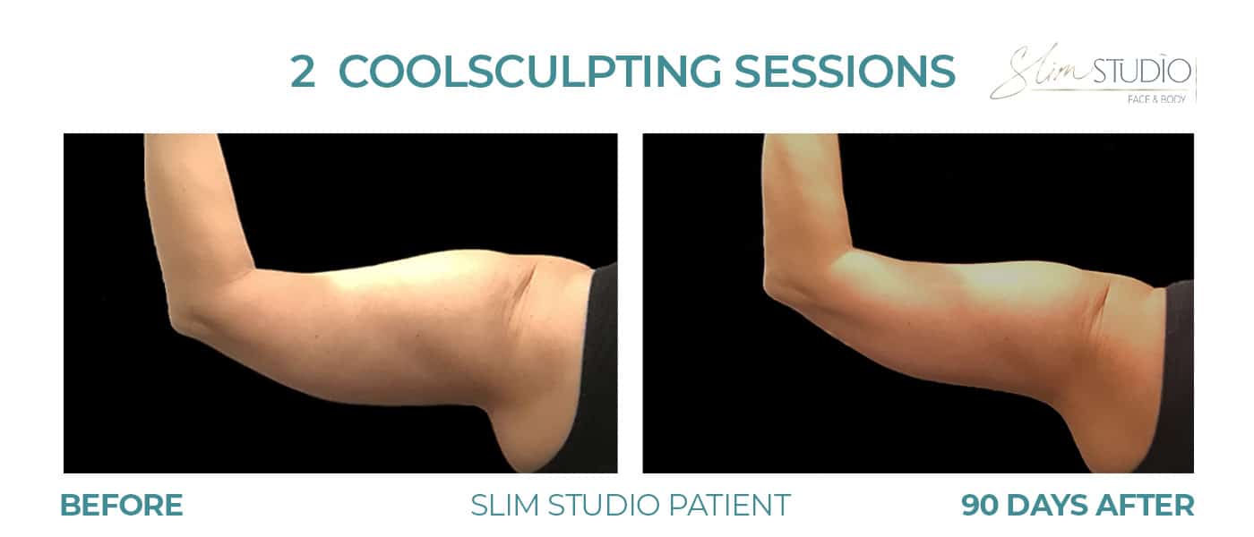 Before and After Image: CoolSculpting - back