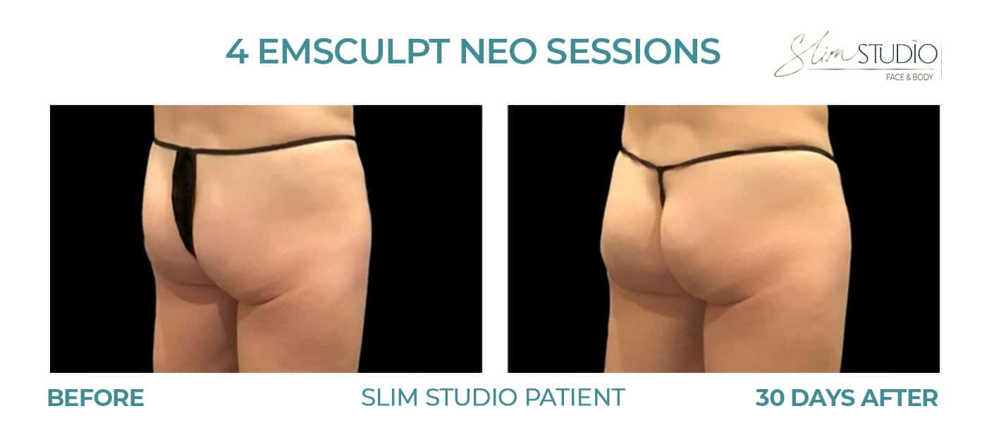 Before and After Image: EMSculpt NEO – Glutes - right-back-oblique