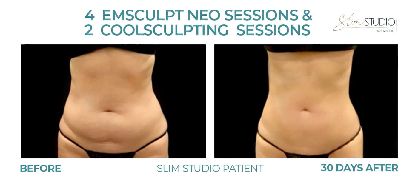 Before and After Image: EMSculpt NEO and CoolSculpting – Abs - front