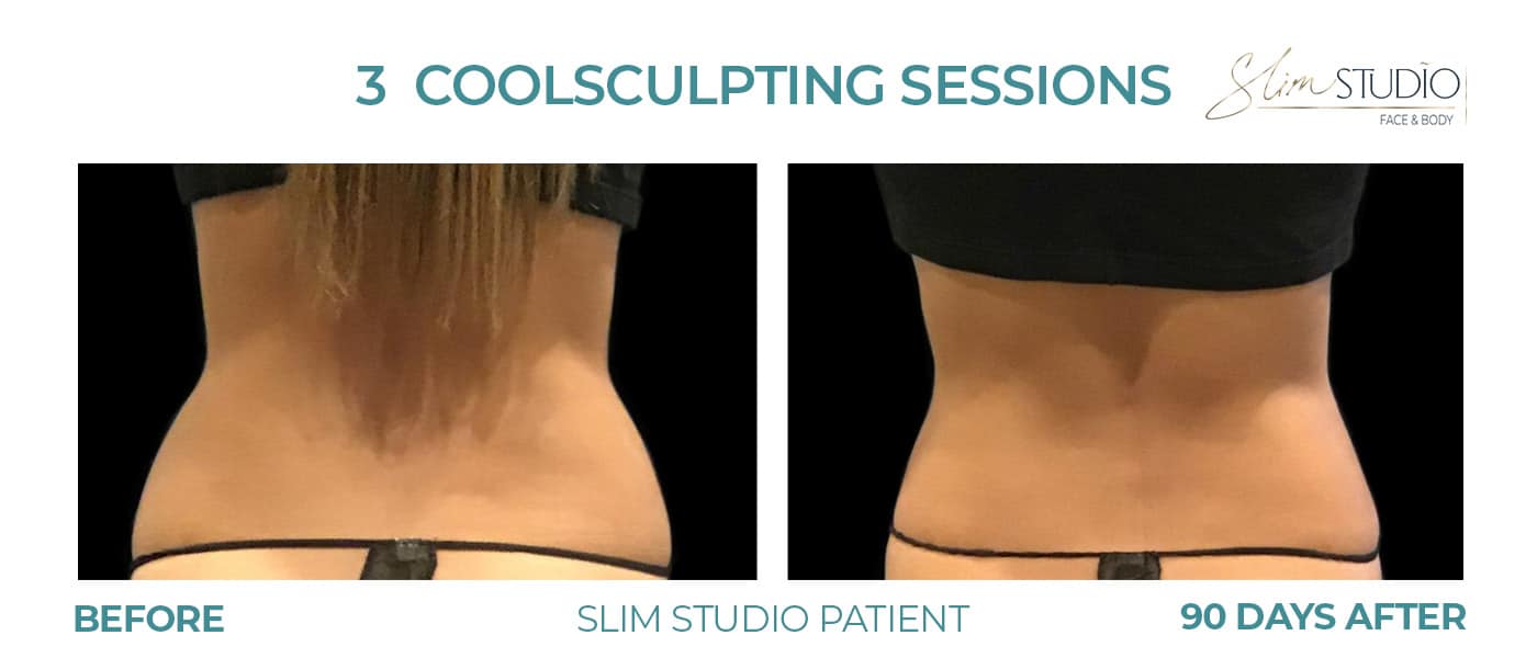Before and After Image: CoolSculpting – Flanks - back