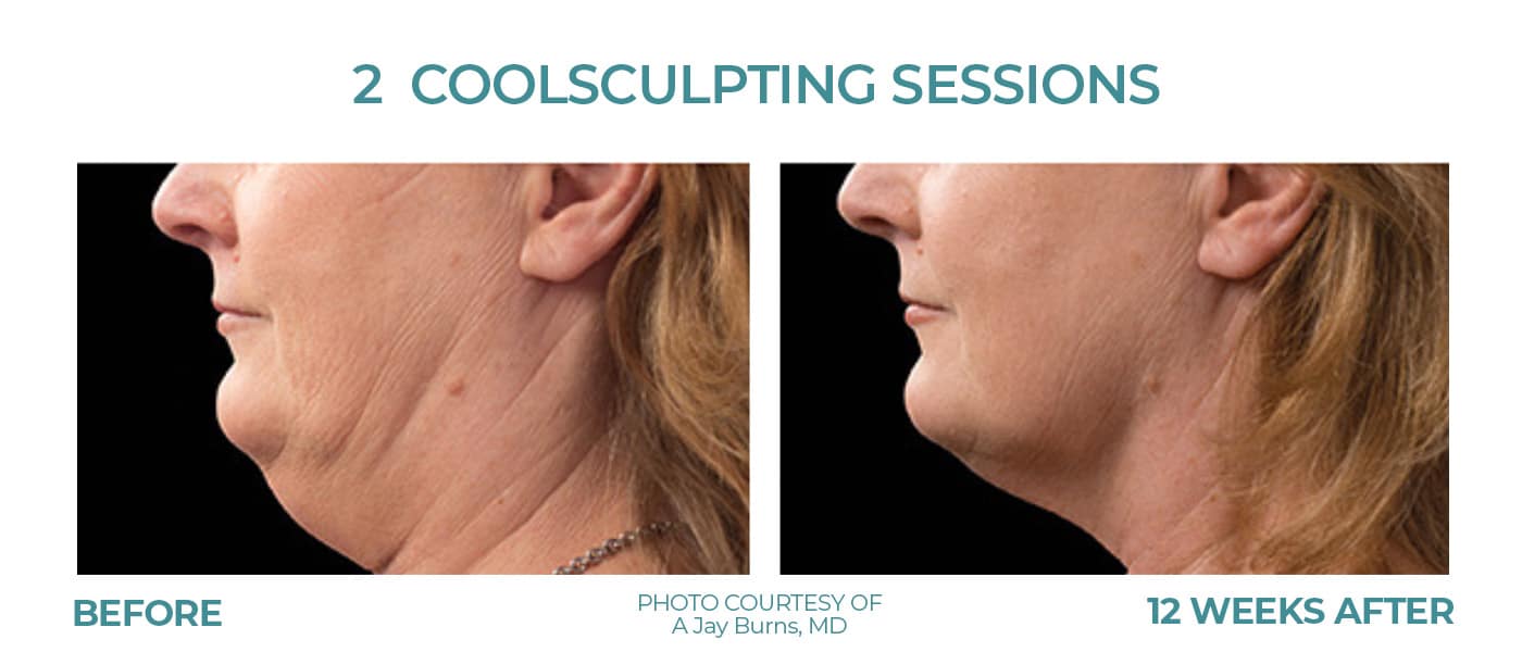 Before and After Image: CoolSculpting – Chin - left-side