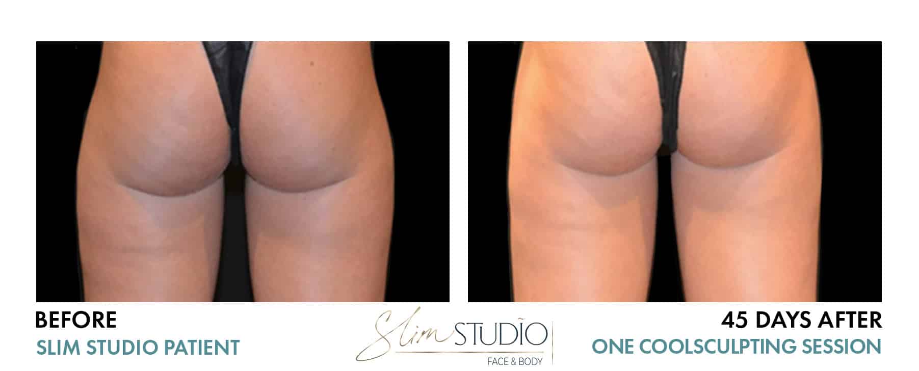 Before and After Image: CoolSculpting – Thighs - back