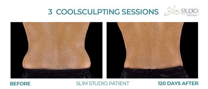 Before and After Image: CoolSculpting – Flanks - back
