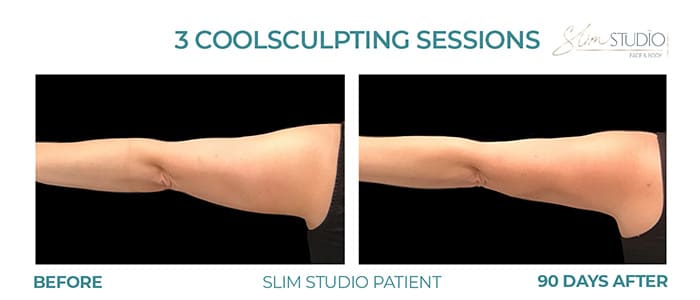 Before and After Image: CoolSculpting – Arms - back