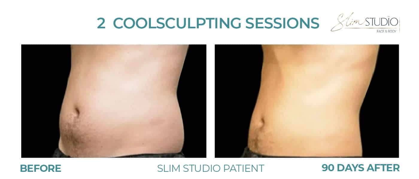 Before and After Image: CoolSculpting – Abs - left-front-oblique