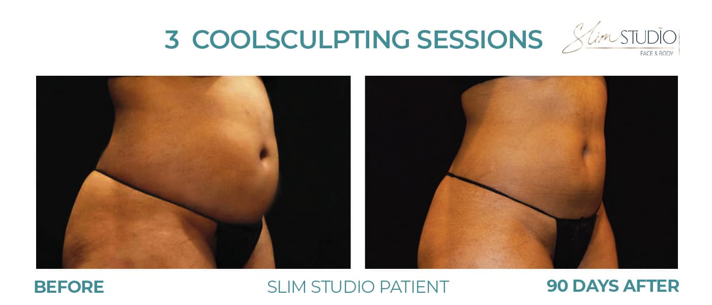 Before and After Image: CoolSculpting – Abs - right-front-oblique