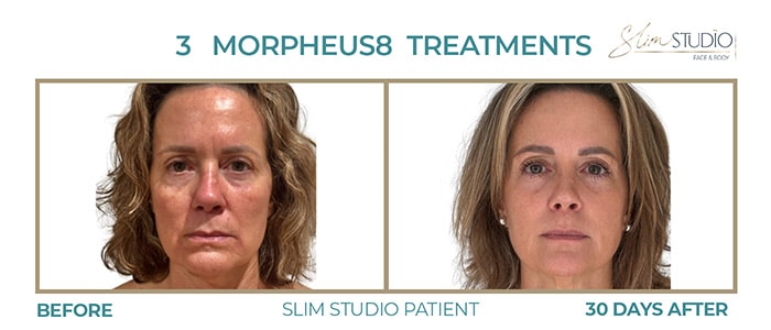 Before and After Image: Morpheus8 - front
