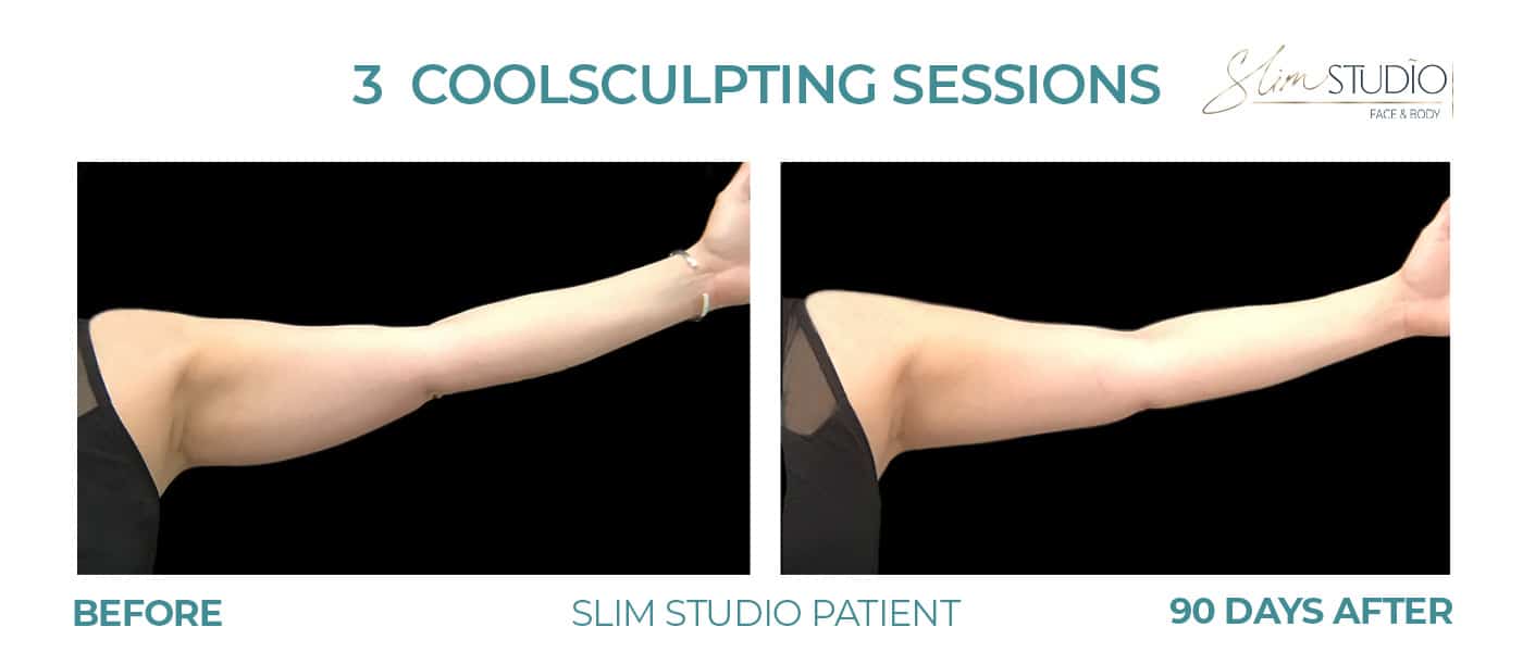 Before and After Image: CoolSculpting – Arms - front