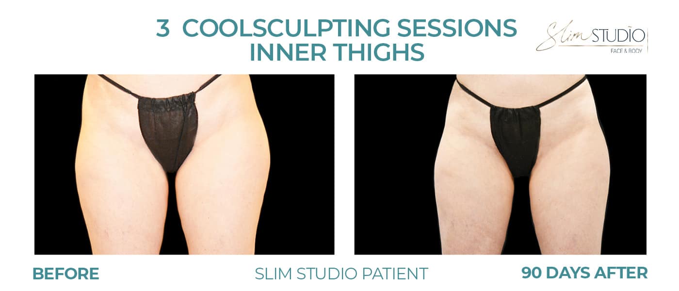 Before and After Image: CoolSculpting – Inner Thighs - front