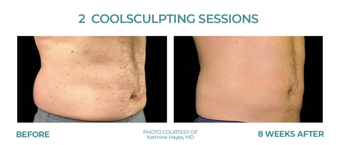 Before and After Image: CoolSculpting – Abs - right-front-oblique