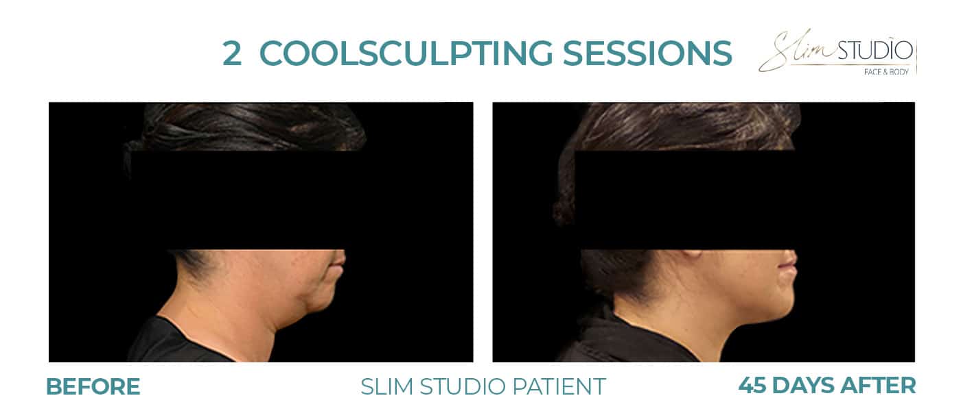 Before and After Image: CoolSculpting – Chin - right-side