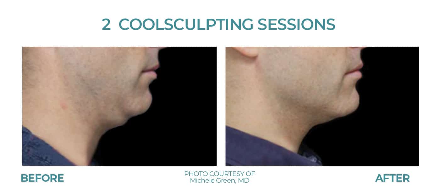 Before and After Image: CoolSculpting – Chin - right-side