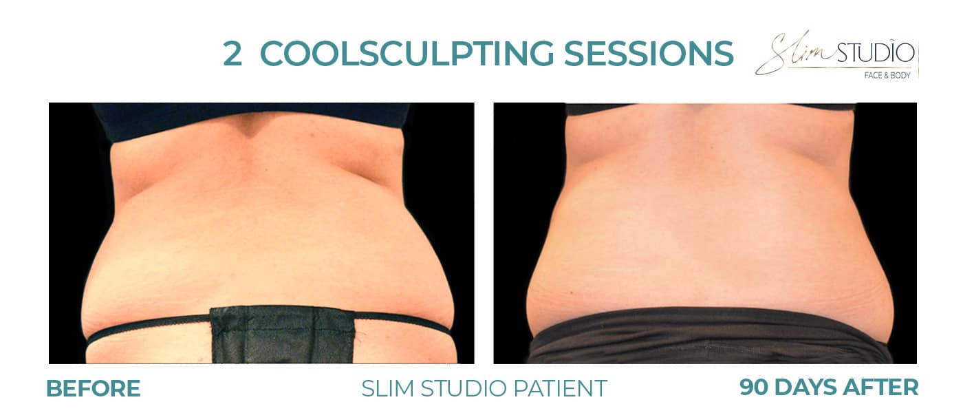 Before and After Image: CoolSculpting – Flanks - back