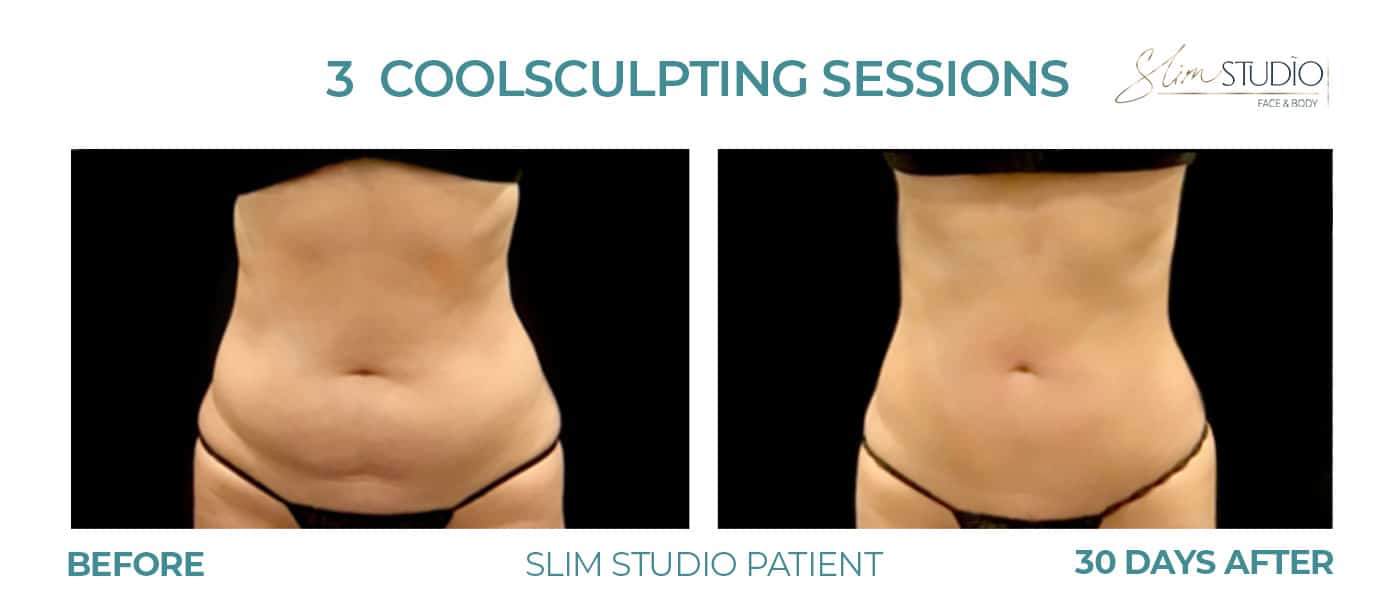 Before and After Image: CoolSculpting – Abs - front