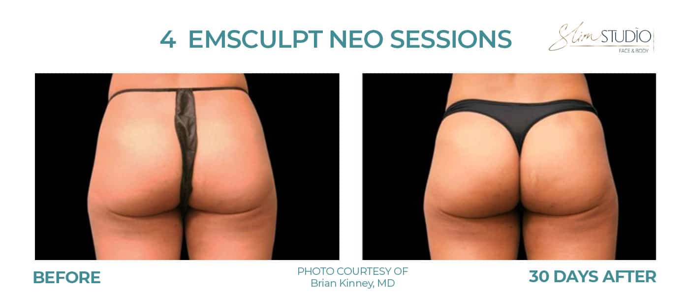 Before and After Image: EMSculpt NEO – Glutes - back
