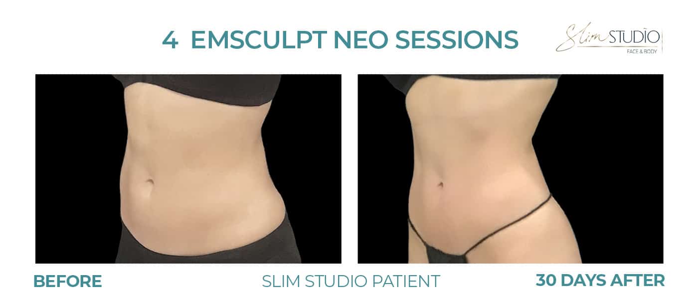 Before and After Image: EMSculpt NEO – Abs - left-front-oblique