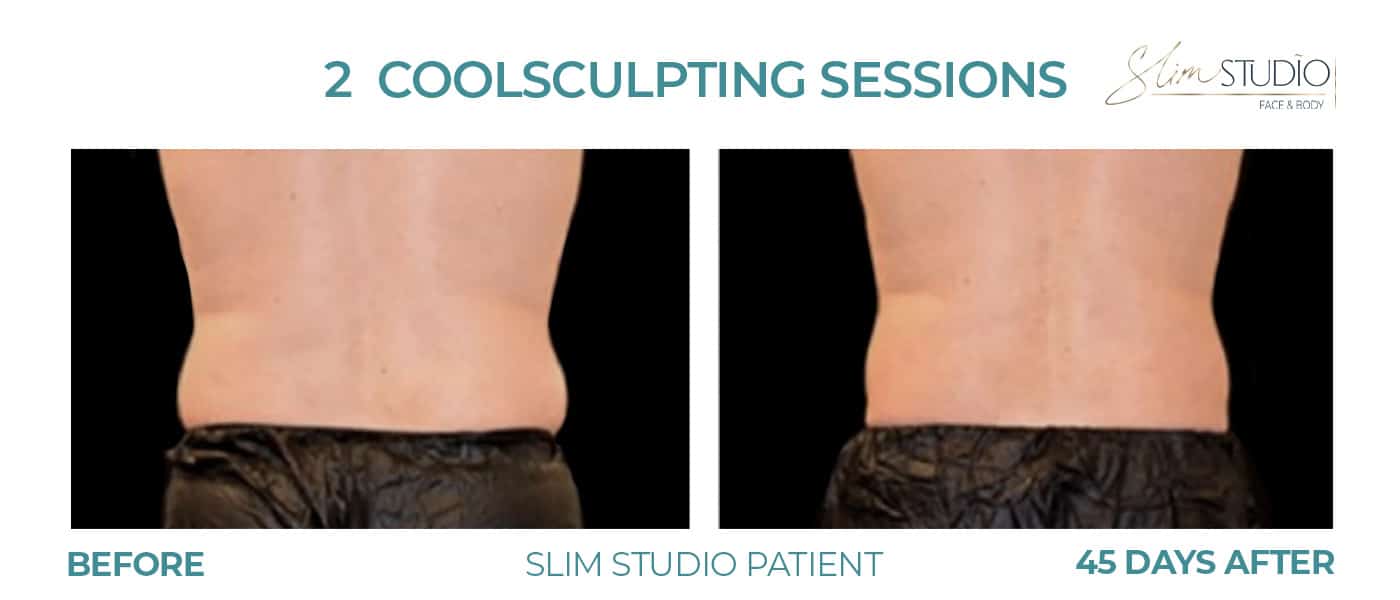 Before and After Image: CoolSculpting – Flanks - back