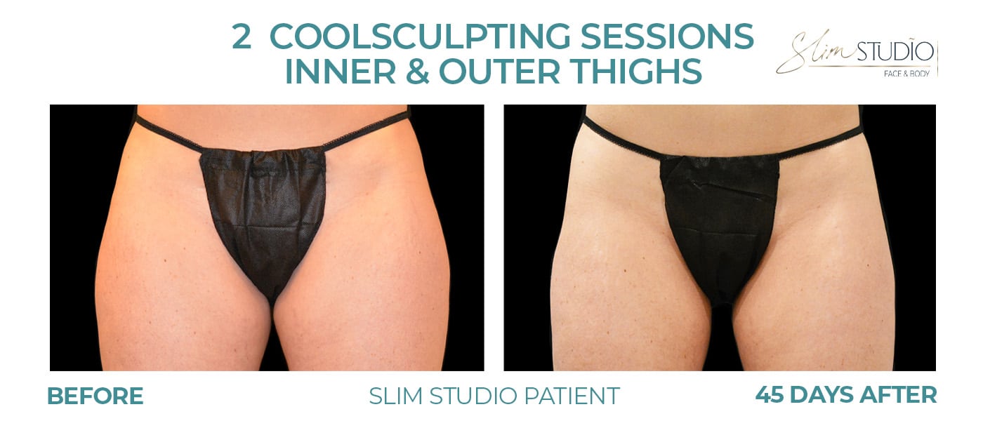 Before and After Image: CoolSculpting – Inner & Outer Thighs - front
