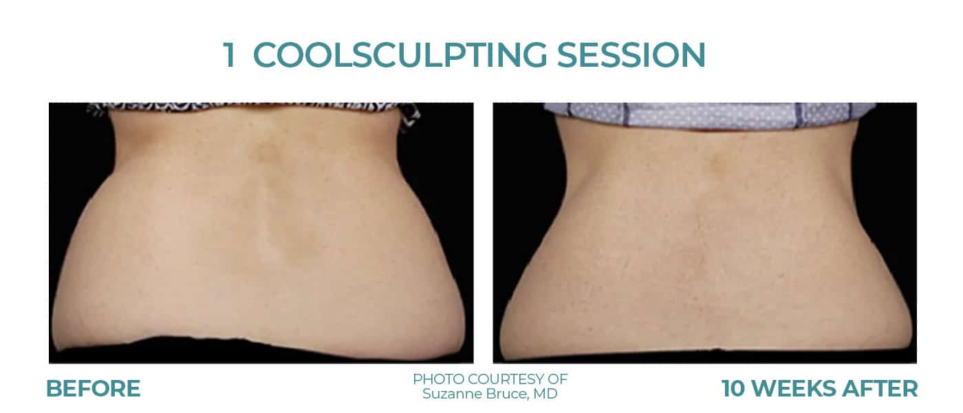 Before and After Image: CoolSculpting – Flanks - back
