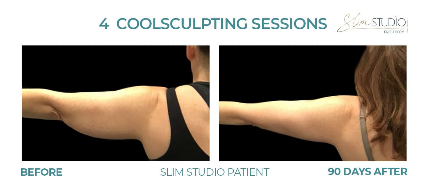 Before and After Image: CoolSculpting – Arms - back