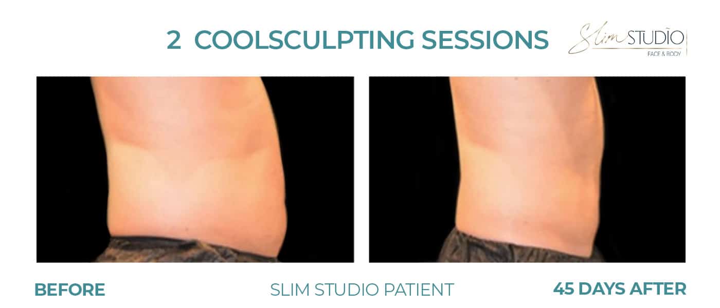 Before and After Image: CoolSculpting – Abs - right-side