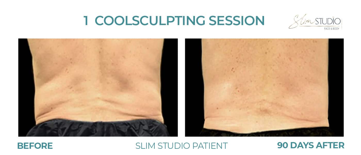 Before and After Image: CoolSculpting – Flanks - back