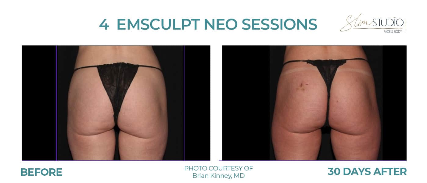 Before and After Image: EMSculpt NEO – Glutes - back