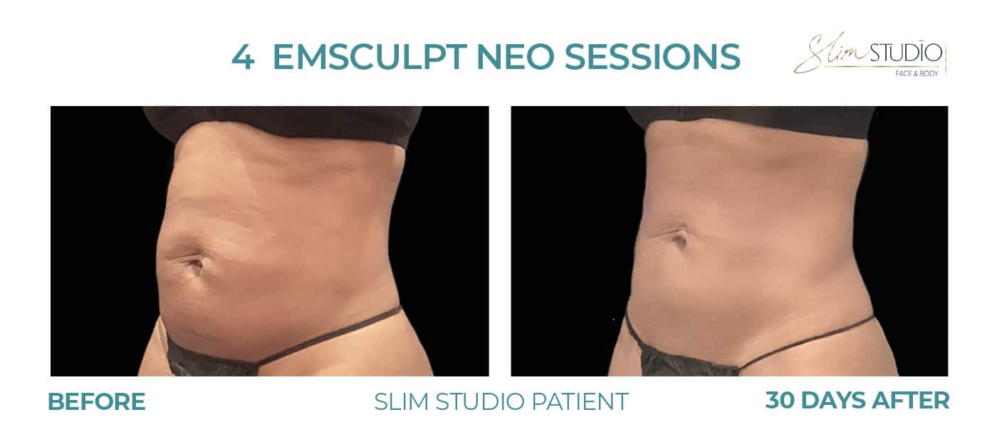 Before and After Image: EMSculpt NEO – Abs - left-front-oblique