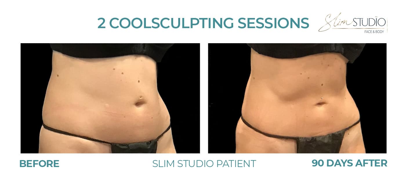 Before and After Image: CoolSculpting – Abs - right-front-oblique