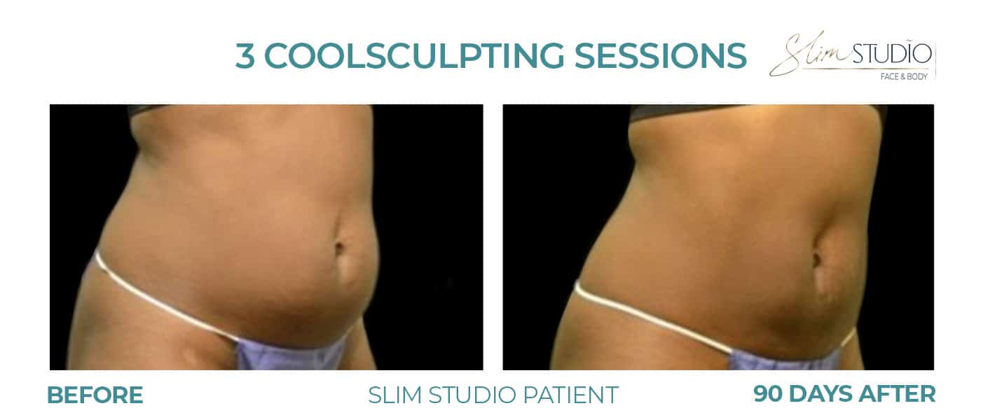 Before and After Image: CoolSculpting – Abs - right-front-oblique