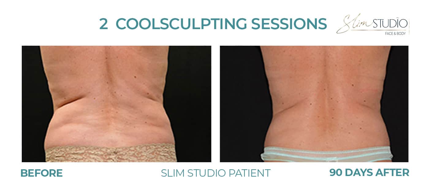 Before and After Image: CoolSculpting – Flanks - back