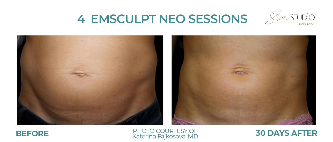 Before and After Image: EMSculpt NEO – Abs - front