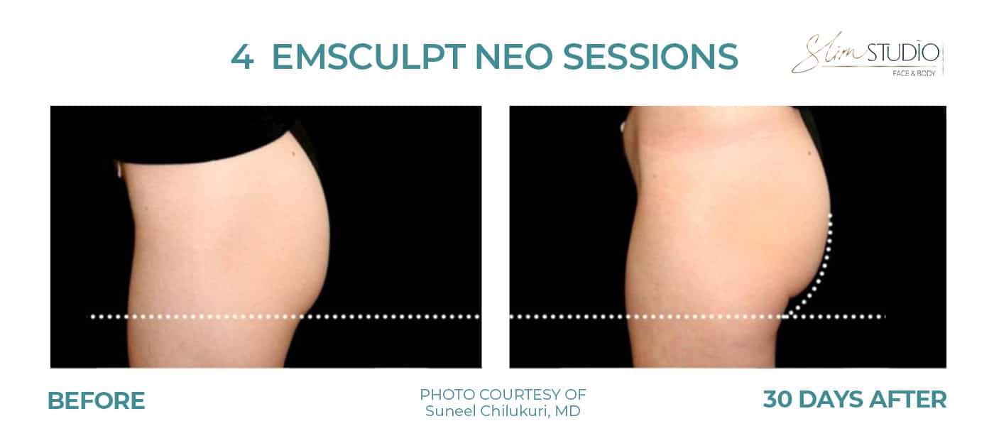Before and After Image: EMSculpt NEO – Glutes - left-side