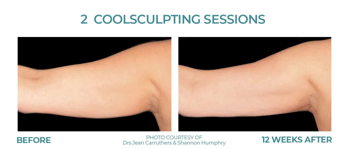 Before and After Image: CoolSculpting – Arms - front