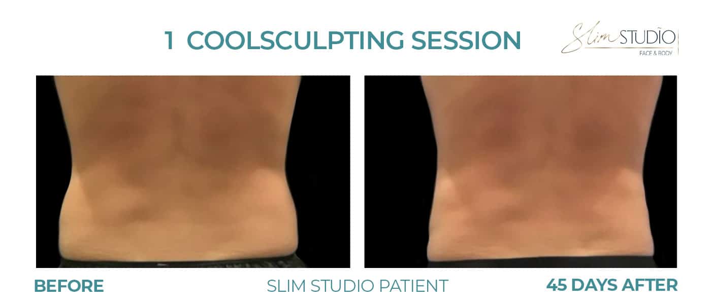 Before and After Image: CoolSculpting – Flanks - back