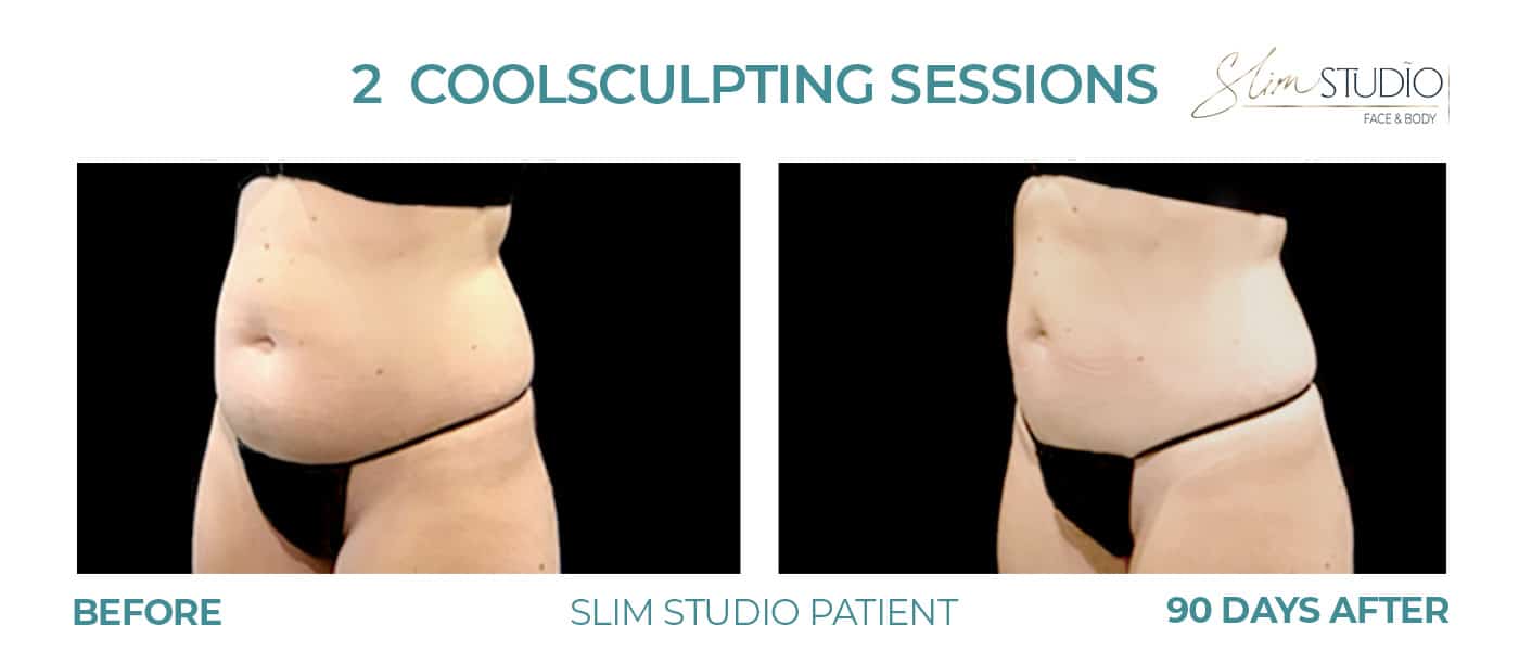Before and After Image: CoolSculpting – Abs - left-front-oblique