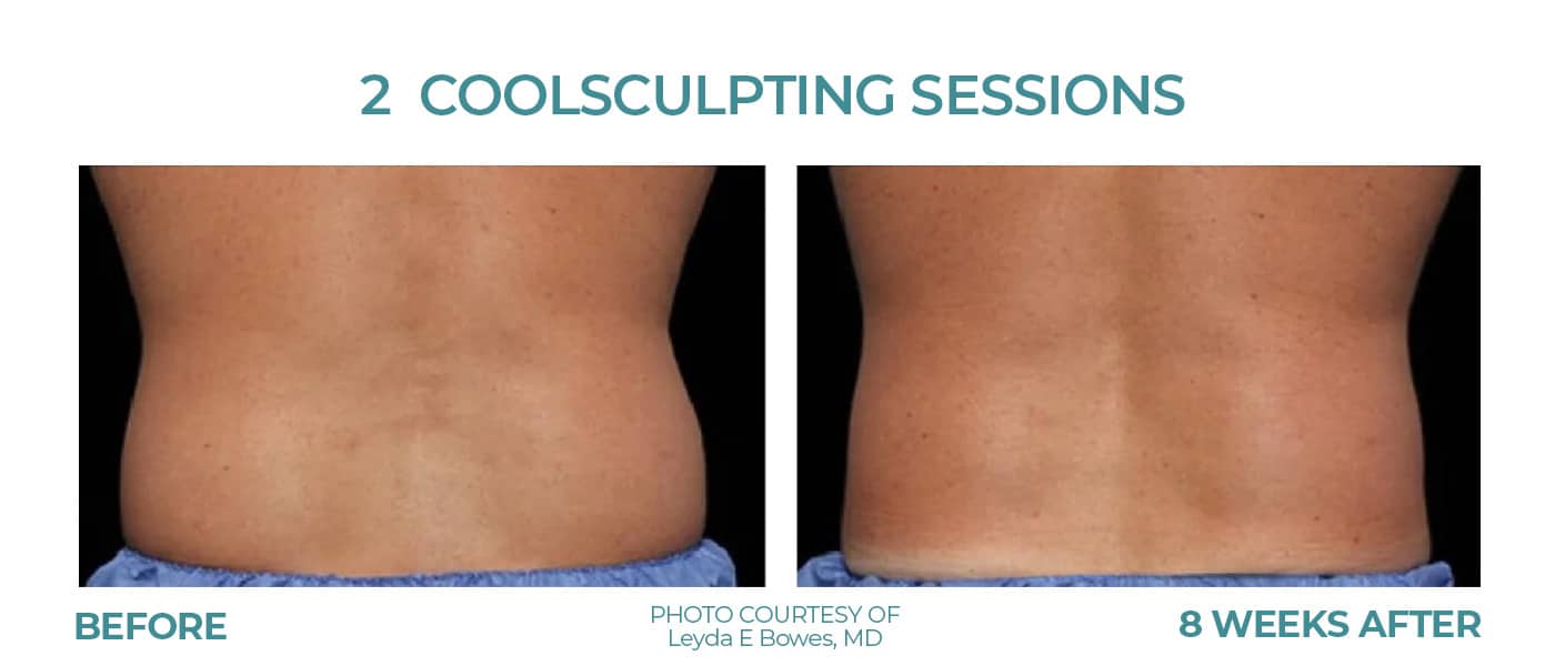 Before and After Image: CoolSculpting – Flanks - back