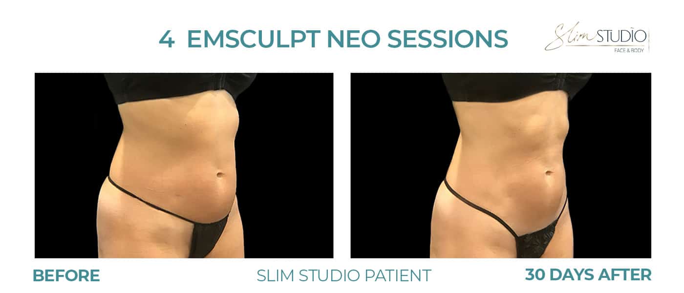 Before and After Image: EMSculpt NEO – Abs - right-front-oblique