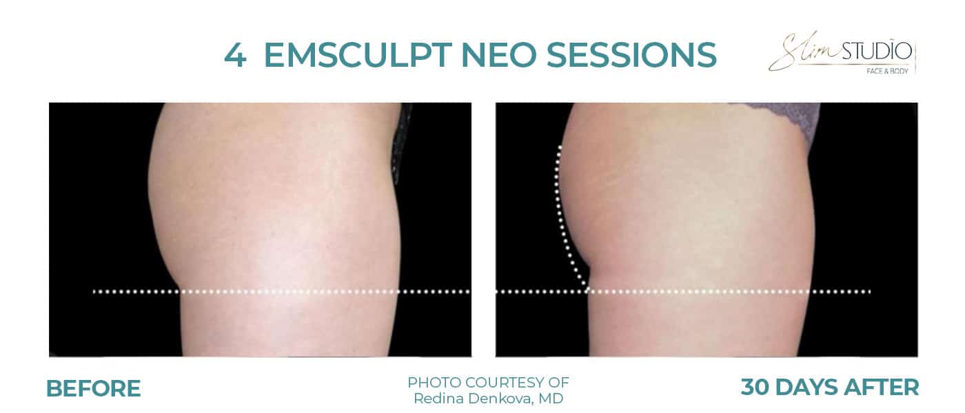 Before and After Image: EMSculpt NEO - right-side