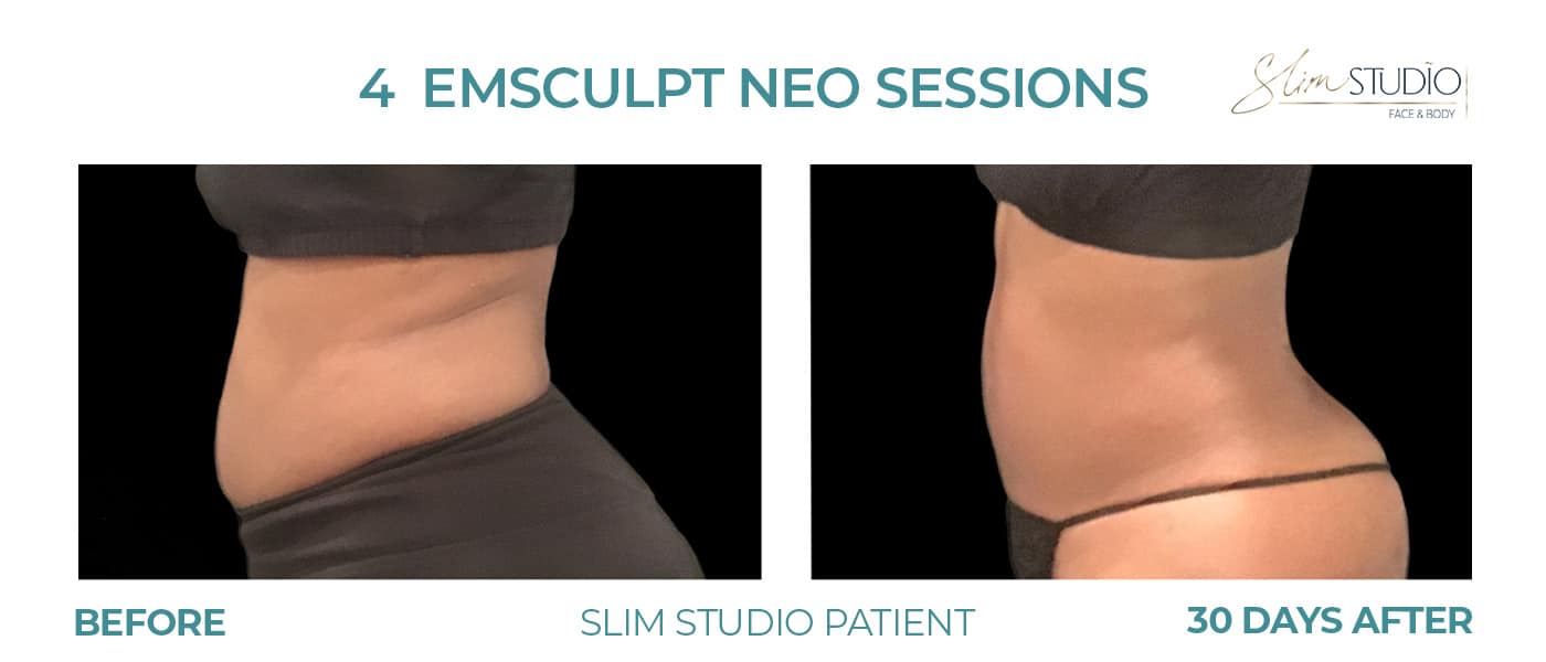 Before and After Image: EMSculpt NEO – Abs - left-side