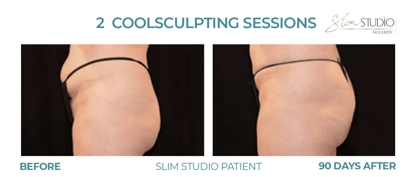 Before and After Image: CoolSculpting – Abs - left-side
