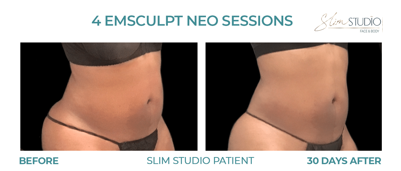 Before and After Image: EMSculpt NEO – Abs - right-front-oblique