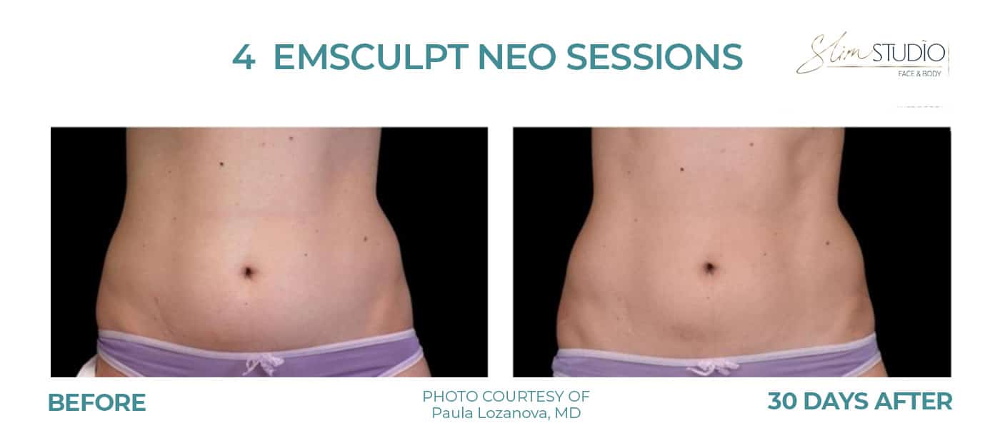 Before and After Image: EMSculpt NEO – Abs - front