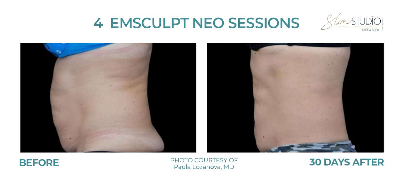 Before and After Image: EMSculpt NEO – Abs - left-side