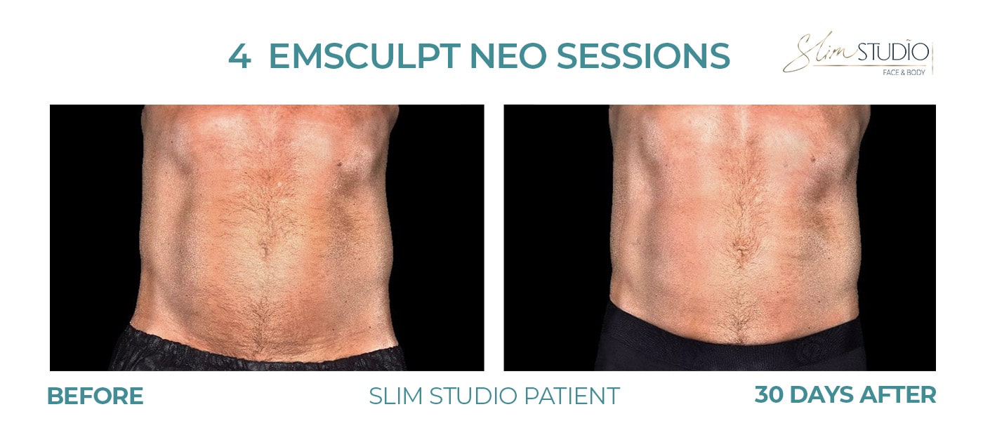 Before and After Image: EMSculpt NEO - front