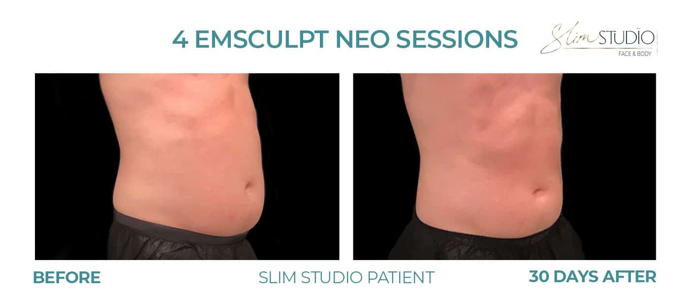 Before and After Image: EMSculpt NEO - right-front-oblique
